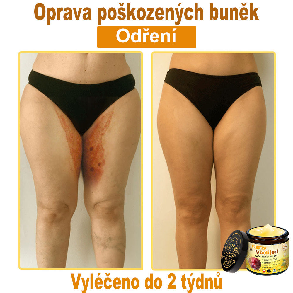 🐝PUROSA® Obnovující krém s včelím jedem｜✅Kompletní řešení pro odolné kožní problémy, jako je stárnutí, ekzém, jizvy a lupénka