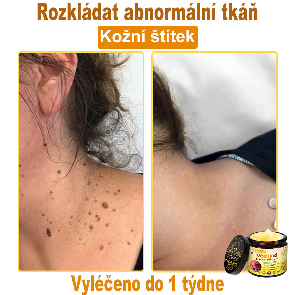 🐝PUROSA® Obnovující krém s včelím jedem｜✅Kompletní řešení pro odolné kožní problémy, jako je stárnutí, ekzém, jizvy a lupénka