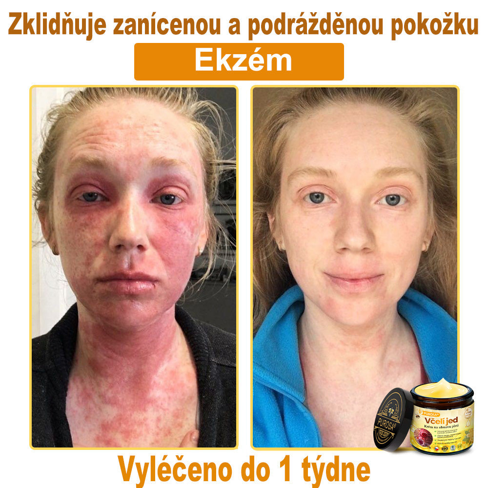🐝PUROSA® Obnovující krém s včelím jedem｜✅Kompletní řešení pro odolné kožní problémy, jako je stárnutí, ekzém, jizvy a lupénka